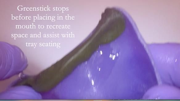 Finlay's Newsletter 62 provision of extractions and metal based complete dentures for Rafique