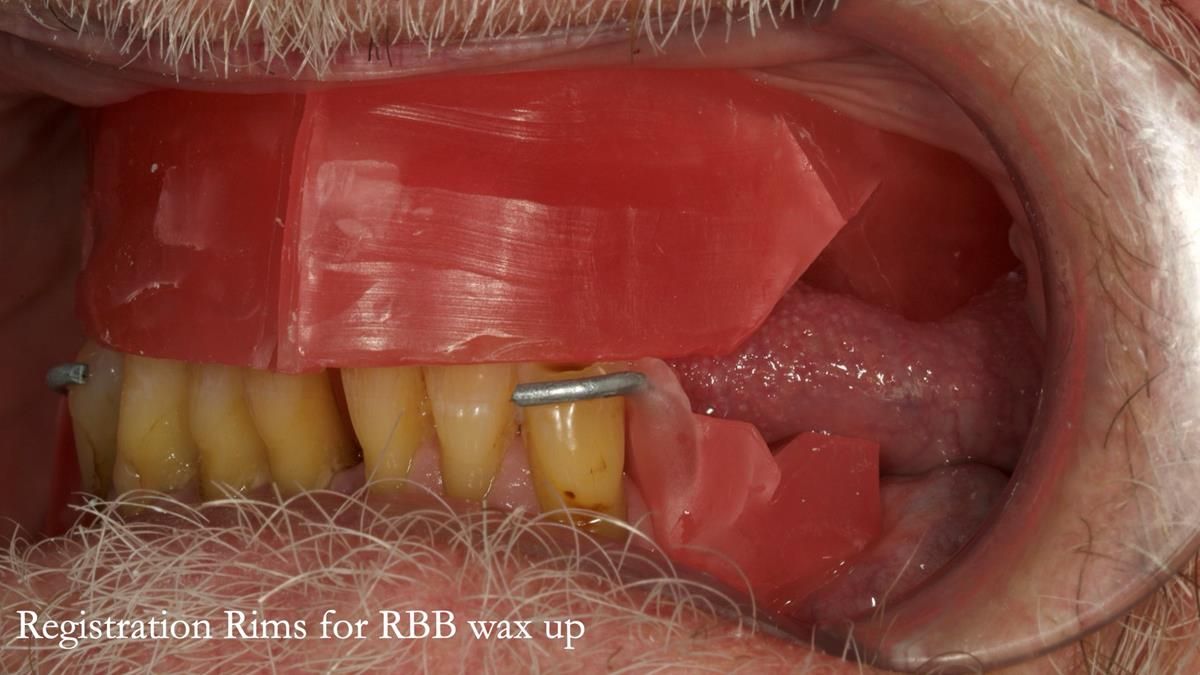 Newsletter 87 – Father Peter: A Partial Denture that needed Minor Miracle