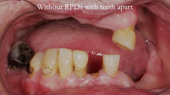 Newsletter 55 Provision of metal based partial dentures for Zephyrine with a repaired cleft lip and palate