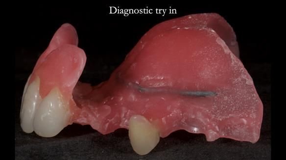 Newsletter 81 - Pam’s Story — how a partial denture changed her life (+ live walkthrough this Thursday)