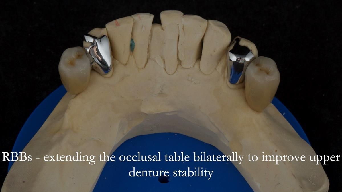 Newsletter 87 – Father Peter: A Partial Denture that needed Minor Miracle