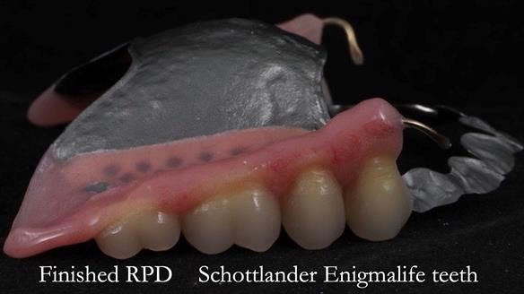 Newsletter 56 showing the making and fitting of a bilateral free end saddle upper removable partial denture (RPD) for patient with pemphigus