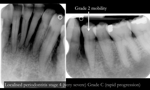 Figure 12 Localised periodontitis stage 4 (very severe) Grade C (rapid progression) - affecting the lower incisors and LL4