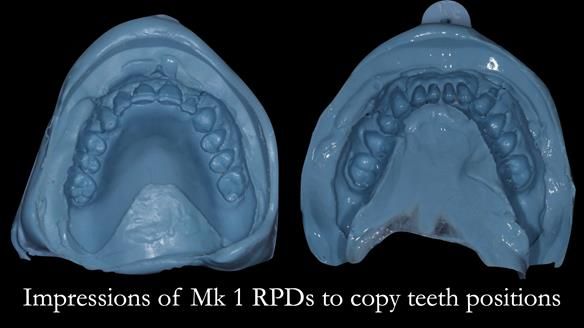 Finlay's Case Study Newsletter 40 - Immediate Mk 1 RPD to Definitive Mk 2 RPD - full protocol