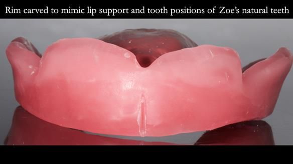 Finlay's Newsletter 58 Gasket upper partial denture for Zoe