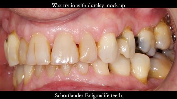 Finlay's Newsletter 64 case study - provision of a Kennedy class 2 metal based Scandinavian RPD for Ian