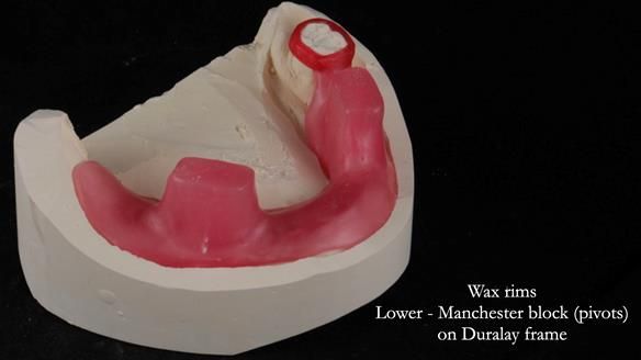 Finlay's Newsletter 59 Ultra hard partial dentures made for Gill