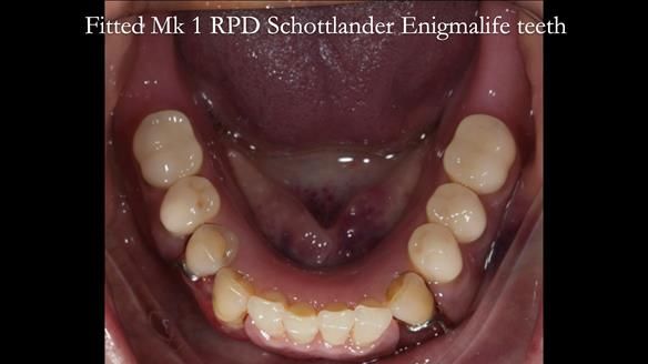 Finlay's Case Study Newsletter 40 - Immediate Mk 1 RPD to Definitive Mk 2 RPD - full protocol