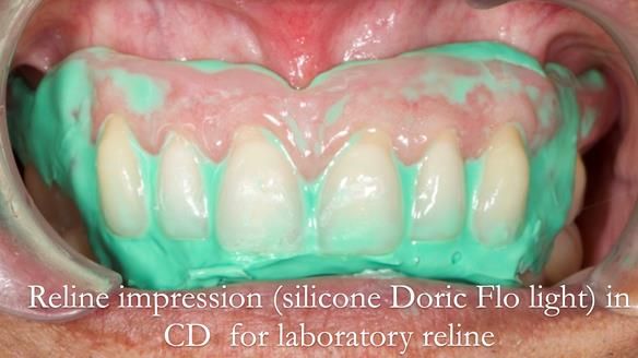 Finlay's Newsletter 62 provision of extractions and metal based complete dentures for Rafique