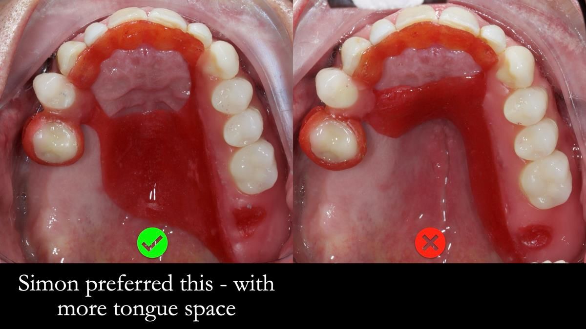 Newsletter 89 – Simon: A Challenging Kennedy Class II Division 1 Upper CoCr Partial Denture with a High Smile Line