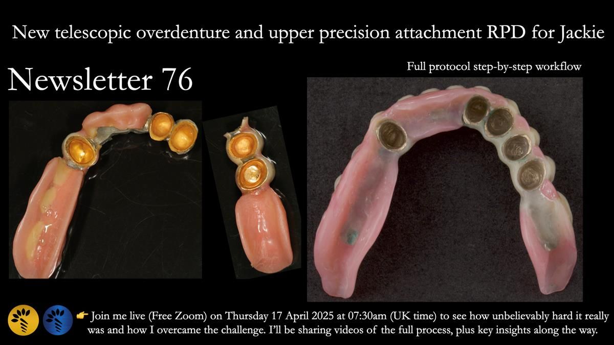 Newsletter 76: Jackie’s case – Telescopic overdenture & precision RPD (the tricky truth!)