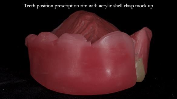 Newsletter 55 Provision of metal based partial dentures for Zephyrine with a repaired cleft lip and palate