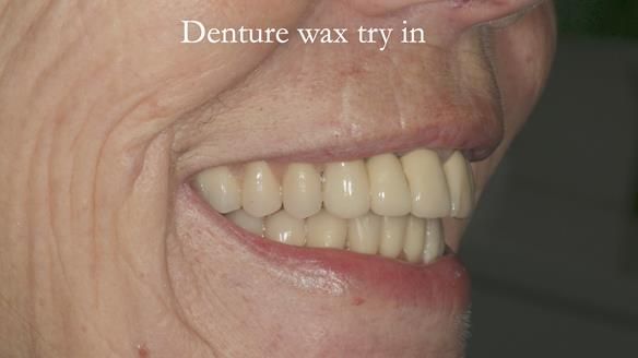 Newsletter 76: Jackie’s case – Telescopic overdenture & precision RPD (the tricky truth!)