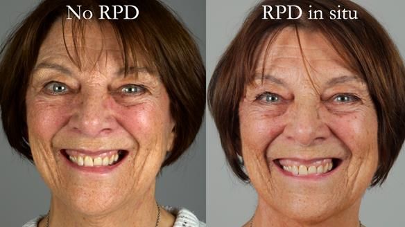 Finlay's Newsletter 61 provision of a lower unilateral free end saddle metal based partial denture for Joyce