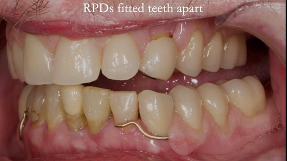 Newsletter 55 Provision of metal based partial dentures for Zephyrine with a repaired cleft lip and palate