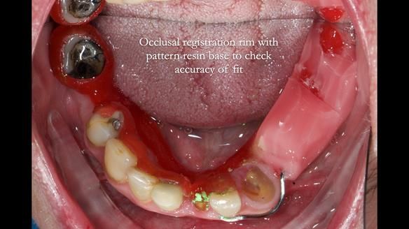 Newsletter 55 Provision of metal based partial dentures for Zephyrine with a repaired cleft lip and palate