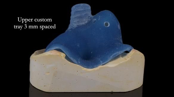 Newsletter 55 Provision of metal based partial dentures for Zephyrine with a repaired cleft lip and palate