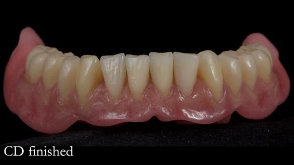 Finlay's Newsletter 62 provision of extractions and metal based complete dentures for Rafique