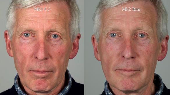 Newsletter 77: Jeremy’s case – immediate complete upper denture