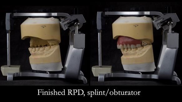 Upper metal base partial denture/occlusal stabilisation splint/obturator - full protocol