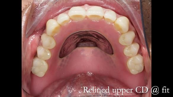 Finlay's Newsletter 62 provision of extractions and metal based complete dentures for Rafique