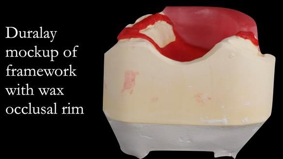 Upper metal base partial denture/occlusal stabilisation splint/obturator - full protocol