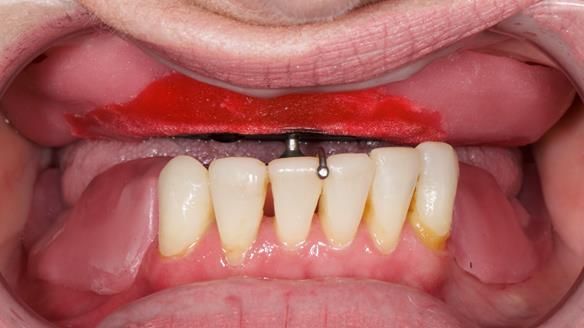 Newsletter 52 Managing Jo’s failing dentition with extractions and Mk 1/Mk 2 complete upper dentures and lower partial dentures FULL PROTOCOL