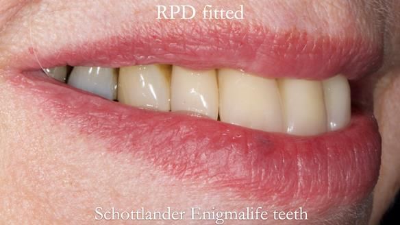 Finlay's Newsletter 59 Ultra hard partial dentures made for Gill