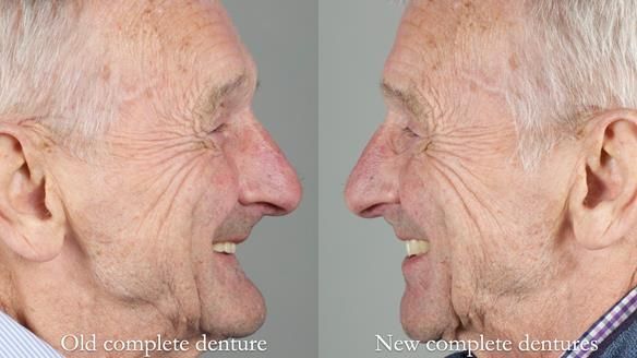 Newsletter 80 - Gordon’s dentures: the one case in 1,000 where my technique failed