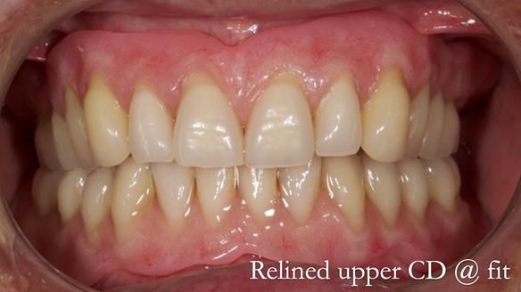 Finlay's Newsletter 62 provision of extractions and metal based complete dentures for Rafique