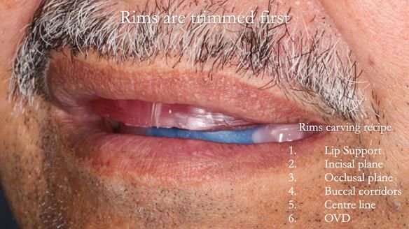 Finlay's Newsletter 62 provision of extractions and metal based complete dentures for Rafique