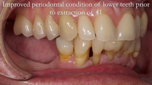 Newsletter 54 case presentation upper complete denture and lower Scandinavian designed hygienic partial denture for David