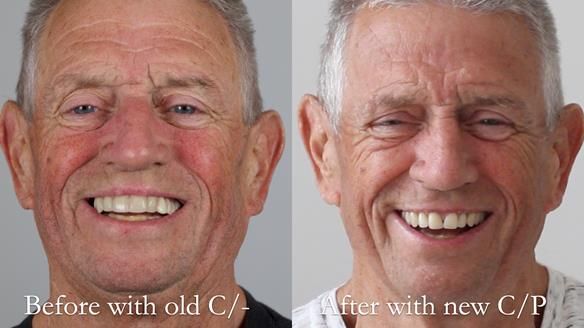 Newsletter 54 case presentation upper complete denture and lower Scandinavian designed hygienic partial denture for David