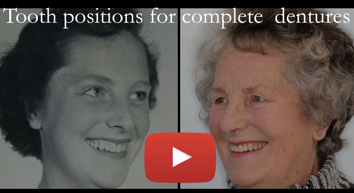 Positioning teeth on complete dentures for a beautiful smile
