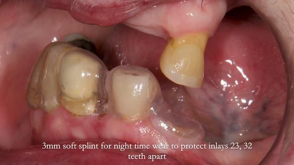 Newsletter 55 Provision of metal based partial dentures for Zephyrine with a repaired cleft lip and palate