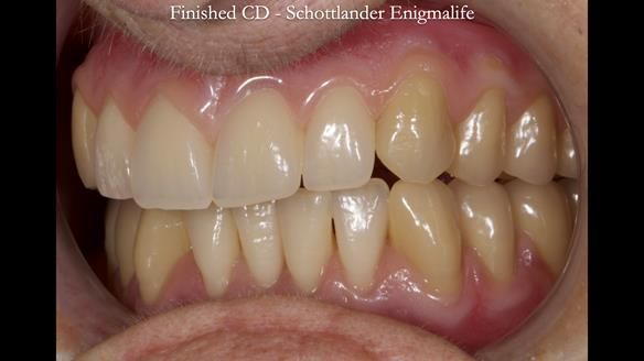 Newsletter 83: Sheila’s Complete Denture Success