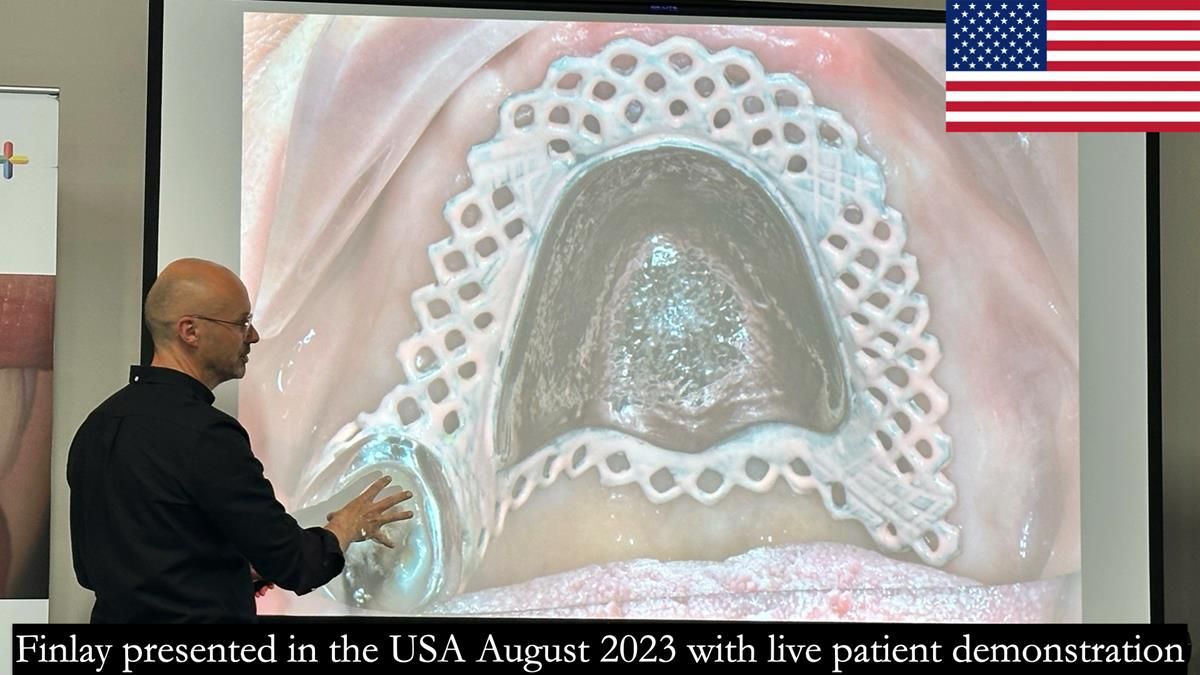 Newsletter 56 showing the making and fitting of a bilateral free end saddle upper removable partial denture (RPD) for patient with pemphigus