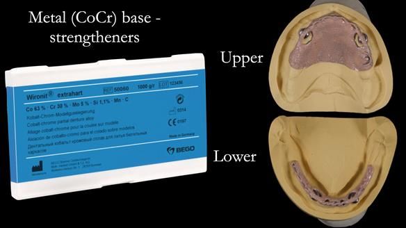 Newsletter 57 showcases the making and fitting process of implant-supported complete dentures for Alisdair