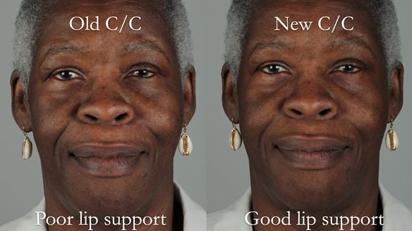 Newsletter 53 showing the making and fitting of ultra life-like dentures for Valena