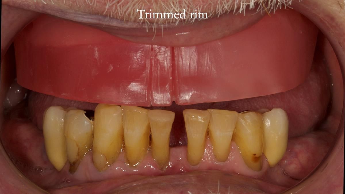 Newsletter 87 – Father Peter: A Partial Denture that needed Minor Miracle