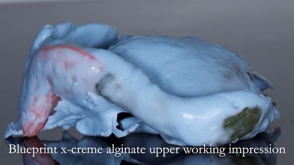 Newsletter 54 case presentation upper complete denture and lower Scandinavian designed hygienic partial denture for David