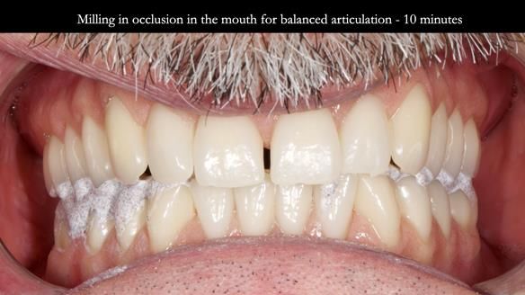 Newsletter 78: What do Clark Gable and a Locator® overdenture have in common?