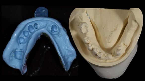 Newsletter 86 Peter the Architect — precision removable partial dentures case study
