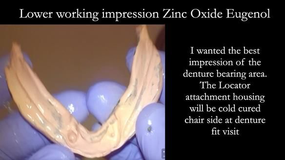 Managing poor implant positioning with complete dentures and Locator attachments - full protocol Newsletter 41