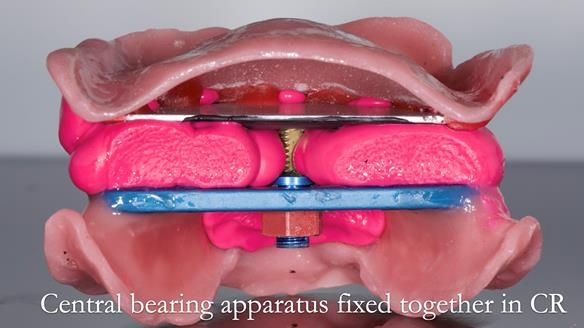 Managing poor implant positioning with complete dentures and Locator attachments - full protocol Newsletter 41