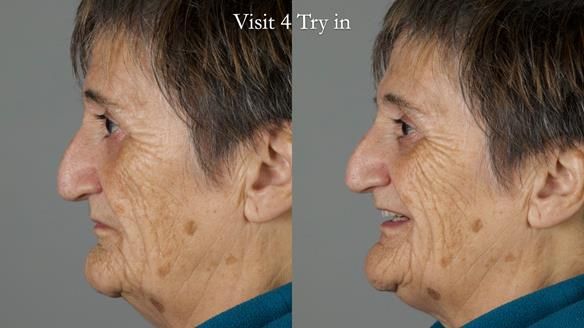 Newsletter 83: Sheila’s Complete Denture Success