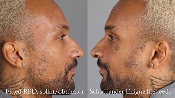 Upper metal base partial denture/occlusal stabilisation splint/obturator - full protocol