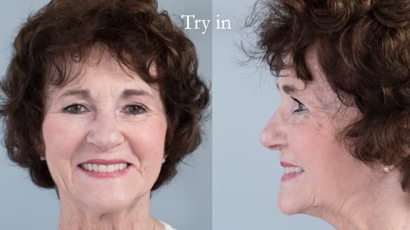 Newsletter 75: Marion’s case - Step-by-step complete denture workflow