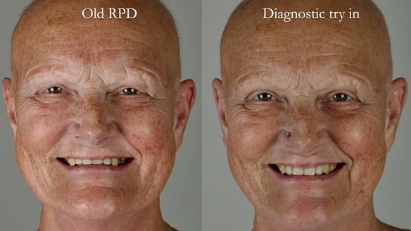 Newsletter 81 - Pam’s Story — how a partial denture changed her life (+ live walkthrough this Thursday)