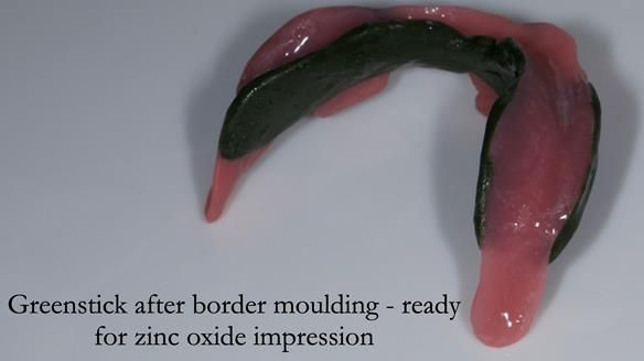 Complete denture Class II div 2 deep overbite Newsletter 39